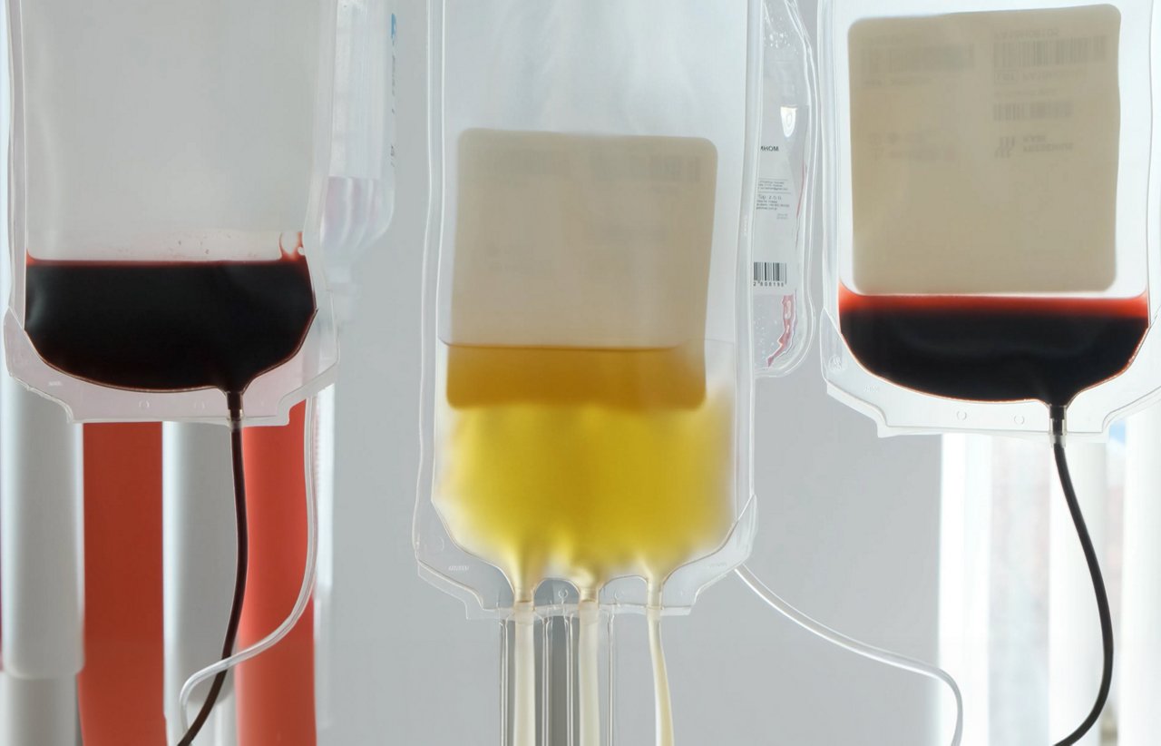 Close-up of multiple clinical blood bags containing separated components, including red blood cells and plasma.
